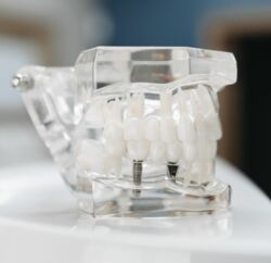 Zahnarztpraxis-Stefan-Windels-Implantate